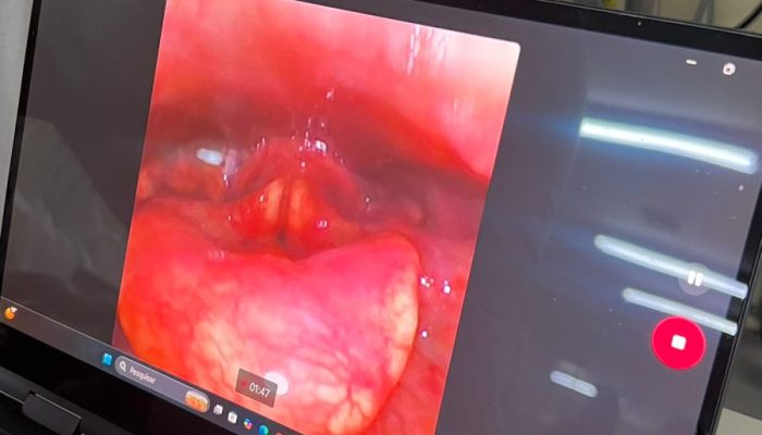 Videondoscopia-da-degluticao-avaliacao-instrumental-faringolaringea-da-seguranca-e-eficiencia-da-deg.jpeg